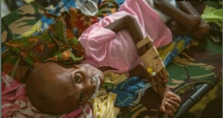 Seorang anak Papua yang menderita gizi buruk terbaring di ranjang rumah sakit untuk menjalani perawatan di Agats, ibu kota Kabupaten Asmat di Papua pada 26 Januari 2018. (Foto: AFP/Bay Ismoyo)